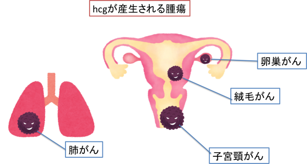 妊娠検査薬で陽性になるhcgが産生される腫瘍